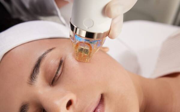 Microneedling/Microchanneling
